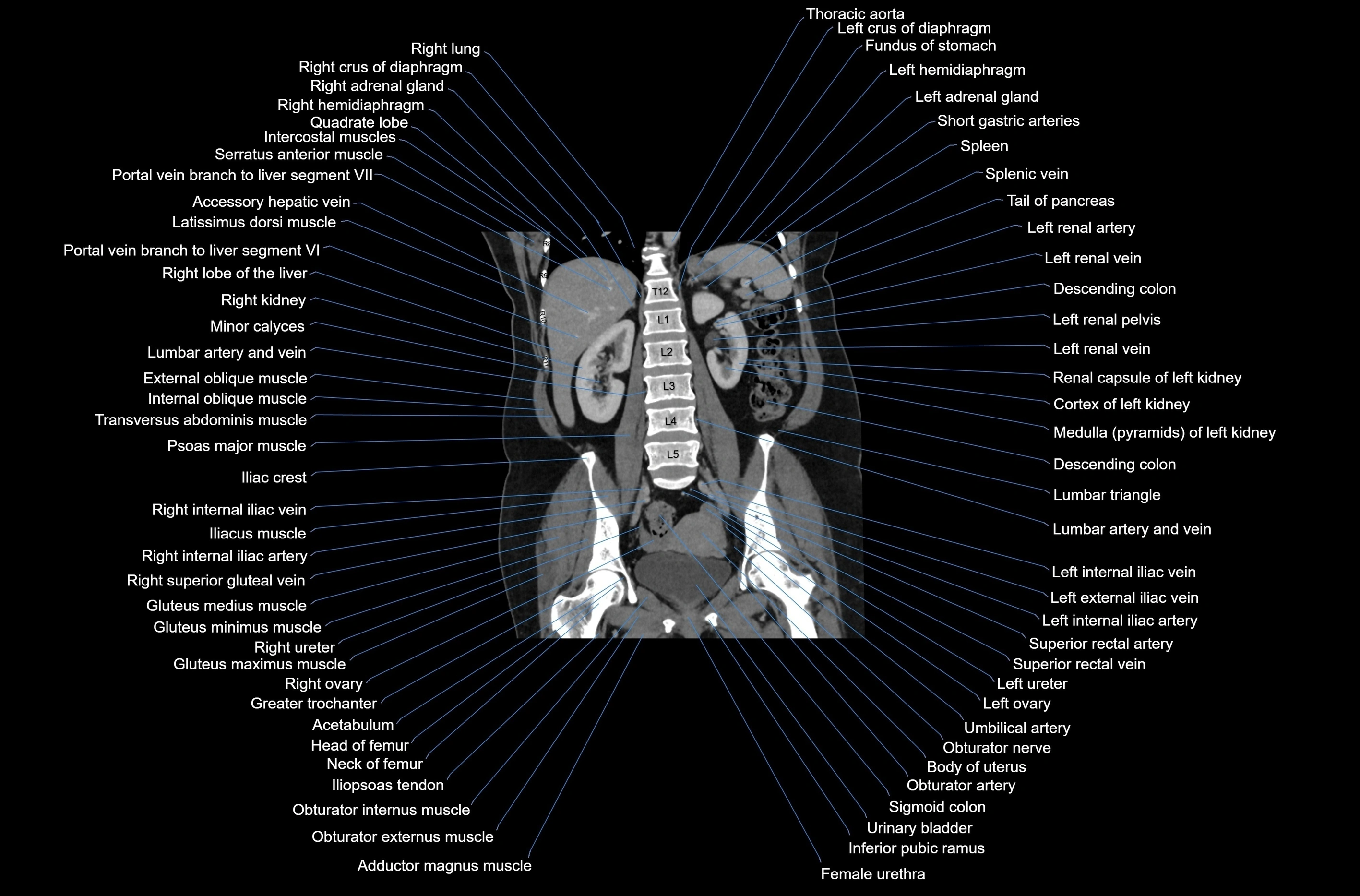 CT abdomen coronal cross sectional anatomy labelled radiology image-00055.webp